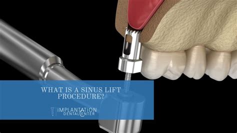 sinus lift port salerno fl|Sinus Lift .